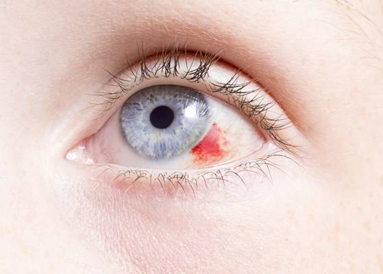 eye conditions